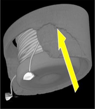 Figure 24. X-ray CT analysis shows a crack in the ferrite core